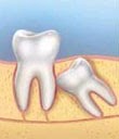 Diagram of angular impaction