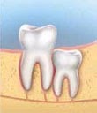 Diagram of vertical impaction