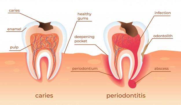 Diagram of a gum disease