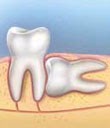 Diagram of horizontal impaction