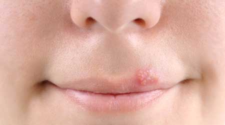 Cold Sores