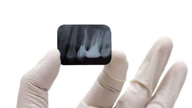 Teeth Xray