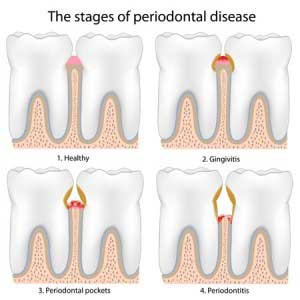 Stages of periodontal disease