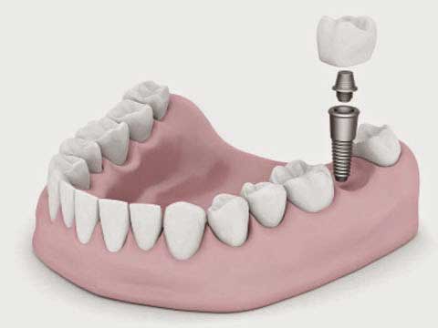 Dental implant