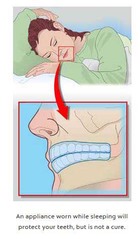 Oral appliance