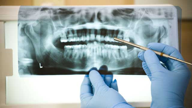 Teeth X-Ray